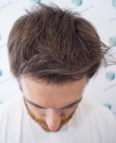 Men's Hair loss Treatments and Solutions
