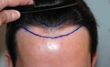 Case performed by Dr. Feriduni – 4723 FU in 3 procedures