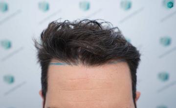Dr. Rafael de Freitas - 3161 Grafts / 8204 Hairs - FUE