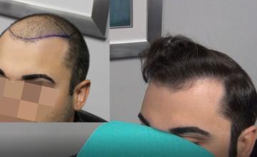 Dr. Bloxham: 3,000 Graft Mega-Session on "Young" Patient | 12 Months After | Feller & Bloxham, NY, NYC, LI