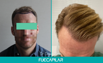 Dr. Turan - FUECAPILAR Clinic, NW IV-V, 4735 grafts, Blonde Patient