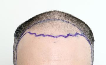 Dr. ROBERT DORIN - NYC - 1915 Frontal/Temple FUE
