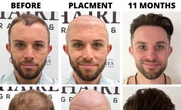 Bogota Hairlines -  2375 Grafts - Dr Sergio Camacho (Diffuse thinning)