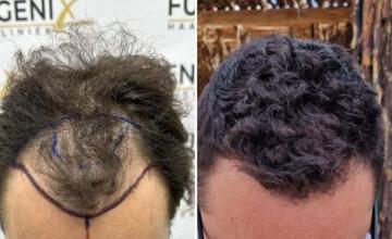 FUEGENIX - 2400 Grafts by Dr. Munib Ahmad - November 2022 - FUE (36 y/o)