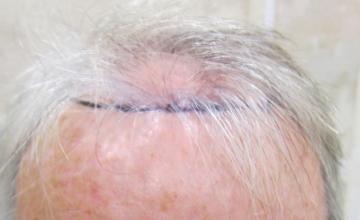 Dr. Timothy Carman- 1900 Total FU grafts; One year Post Op Result