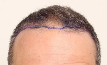 DR. DORIN - Thinning Class 4>5A -  FUE 6 months