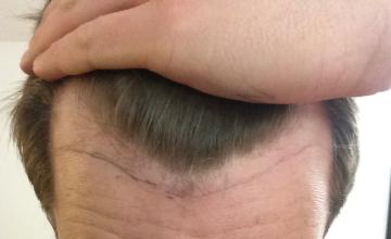 *VID/PICS* 2,000 Graft Hairline Case / Feller &amp; Bloxham / Dr. Blake Bloxham (NY)