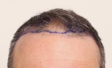 Dr. DORIN - "Let the hair begin" - 6 months out FUE front/crown