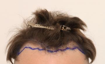 Dr. Robert Dorin ~ 1754 Graft FUE ~ 4 month progress