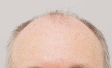 Dr B Farjo 3640 FUT + FUE combo  (Stage one)