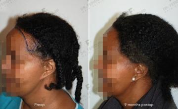 Case performed by Dr. Feriduni – 2029 FU in 1 procedure