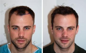 Case performed by Dr. Feriduni – 3427 FU in 1 procedure