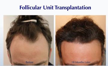#BAM Natural Flow to a Hairline (3061 grafts): Carlos K. Wesley, M.D. (NYC & LA)