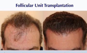 #BAM Male FUT (3389 grafts): Carlos K. Wesley, M.D. (NYC & LA)