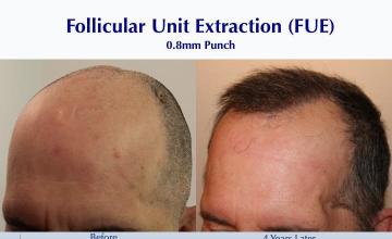 #BAM Frontal Scalp Scar Coverage (2530 FUE grafts): Carlos K. Wesley, M.D. (NYC & LA)