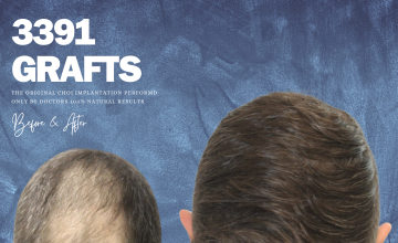 Dr. Christos Tsalakos CHOIEXPERT- 3,391 Grafts FUE