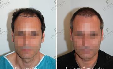 Case performed by Dr. Feriduni – 5556 FU in 2 procedures