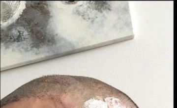 Dr. Maras at HDC clinic in Cyprus, 440 FUE grafts for temporal peaks, post 9 years result