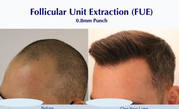 Men's FUE Hairline and More (3157 FUE grafts): Carlos K. Wesley, M.D. (NYC & LA)