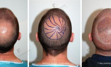 Repair case performed by Dr. Feriduni – 7495 FU in 2 procedures