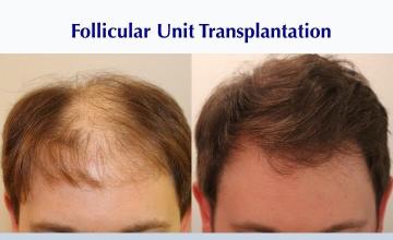 #BAM Male FUT (3298 grafts): Carlos K. Wesley, M.D. (NYC & LA)