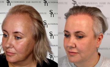 Female before and after FUE hair transplant