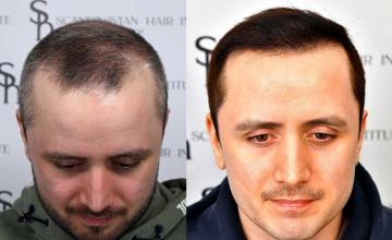 Before and after