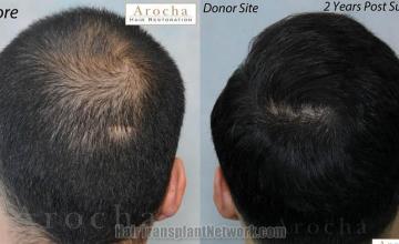 Hair restoration procedure before and after results