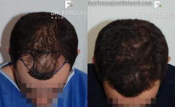 Before and after hair transplant procedure images