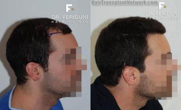 Hair restoration procedure before and after results