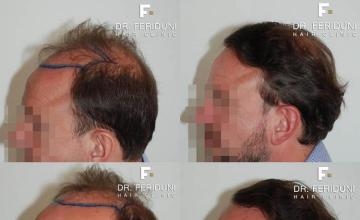 Hair transplantation surgery before and after photos