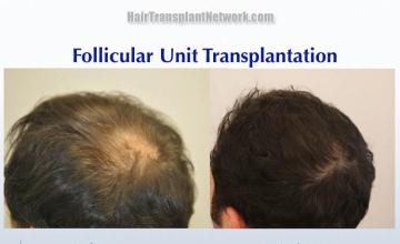  Before and after hair transplant surgery result images