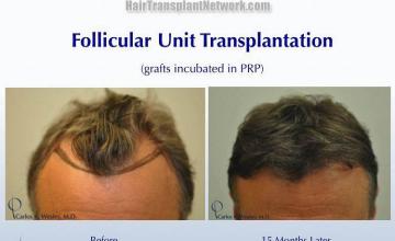 Front view - Before and after hair transplant surgery