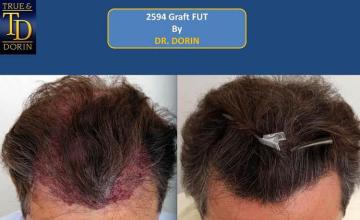 Hair restoration surgery before and after images