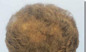 Hair restoration procedure results