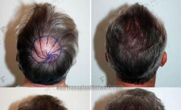 Surgical hair transplantation result photographs