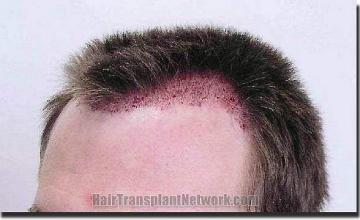 Hair restoration procedure results
