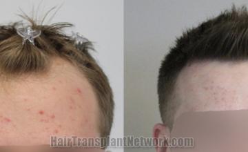 Front view - Before and after  
