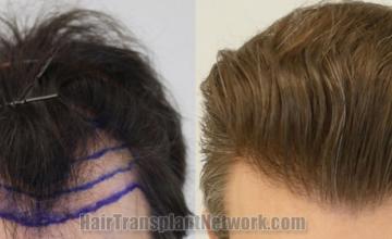 Front view - Before and after  ,