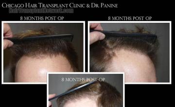 Hair restoration surgery before and after photos