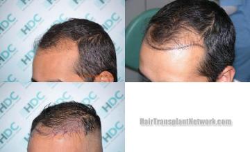 Hair transplantation surgery before and after pictures