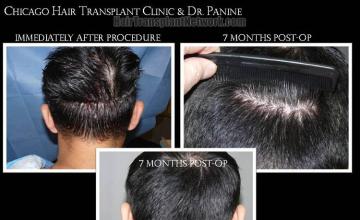 Hair restoration procedure before and after pictures