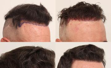  before and after photos