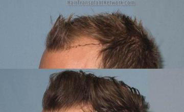 Hair transplantation surgery before and after photos