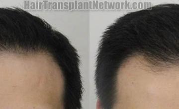Hair restoration procedure before and after results