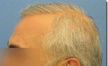 Hair restoration procedure results