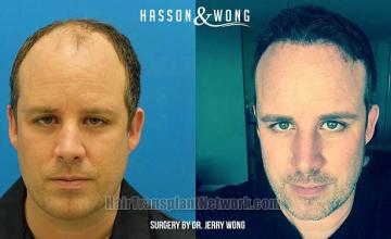 Hair restoration procedure before and after results