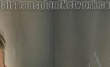 Front view - Before and after hair restoration procedure