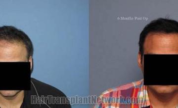 Hair restoration procedure before and after results