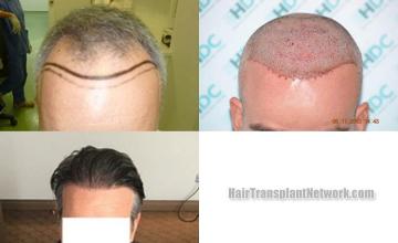 Hair transplantation surgery before and after photos